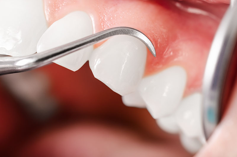Estética dental en Pinto y Ciempozuelos, blanqueamiento dental en Pinto, carillas dentales en Pinto.