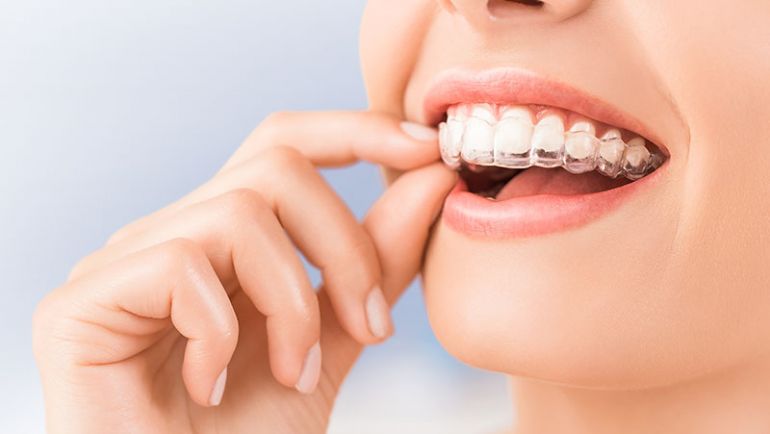 Ortodoncia invisible en Pinto